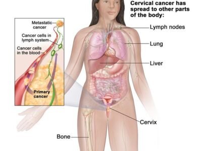 Blood Cancer Symptoms