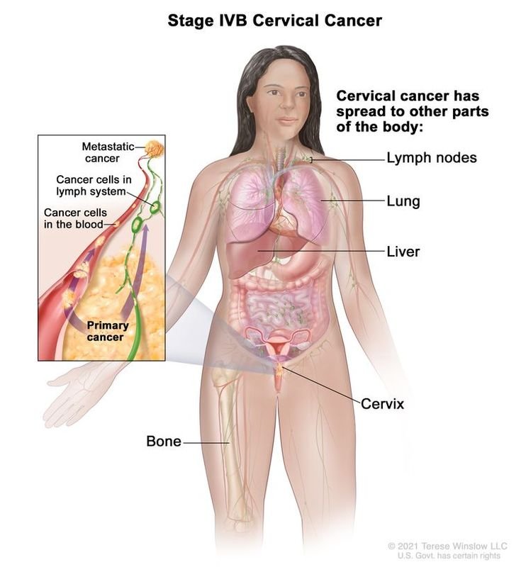 Blood Cancer Symptoms